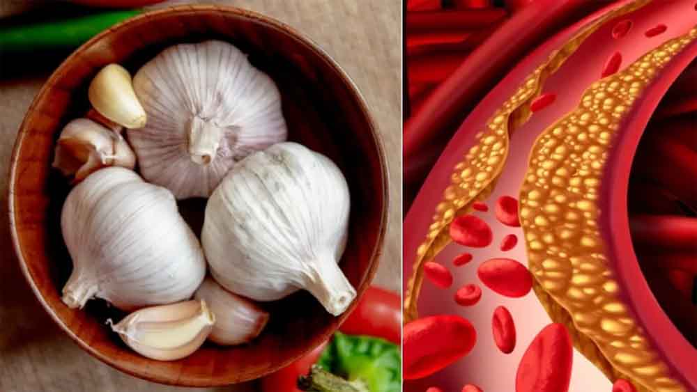 कोलेस्ट्रॉल समेत कई समस्याओं का रामबाण इलाज, सुबह-सुबह खाली पेट कच्चा लहसुन खाएं, मिलेंगे जबरदस्त फायदे 6 कोलेस्ट्रॉल समेत कई समस्याओं का रामबाण इलाज सुबह सुबह खाली पेट