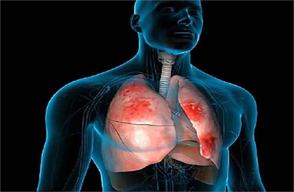 निमोनिया भी एक गंभीर बीमारी बन कर सामने आ रही, लक्षणों को न करें नजरअंदाज, जा सकती है जान 6 निमोनिया भी एक गंभीर बीमारी बन कर सामने आ रही