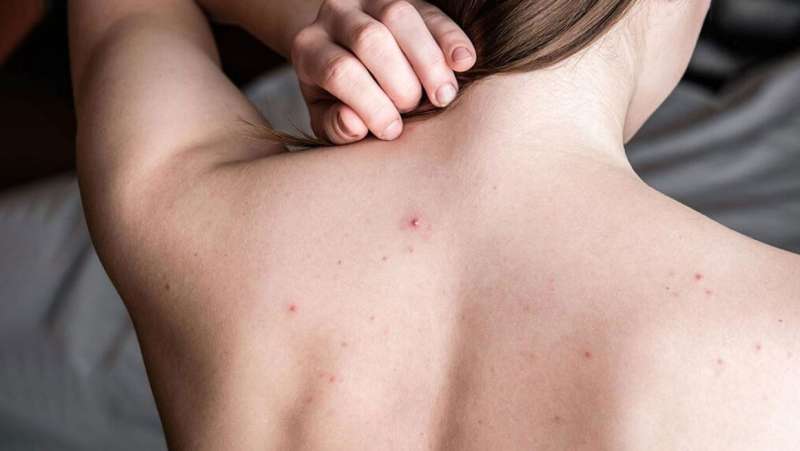 पीठ के दाने फुंसियों से परेशान नहाते वक्त अपनाएं ये आसान