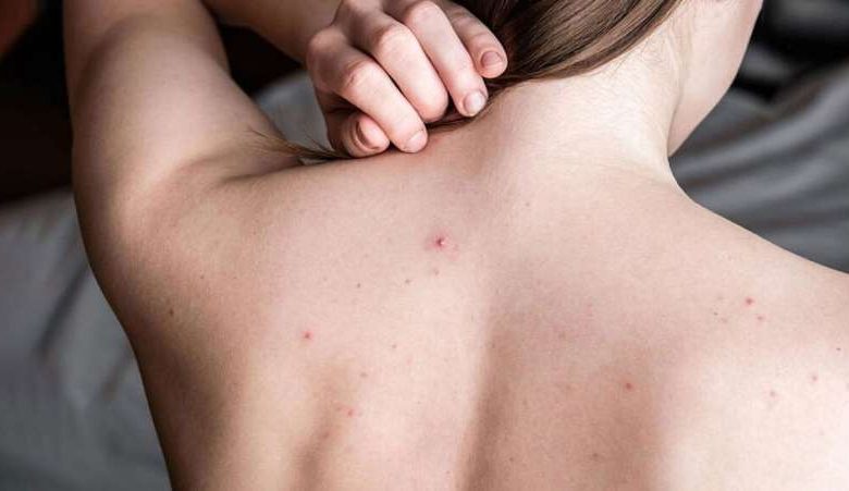 पीठ के दाने फुंसियों से परेशान नहाते वक्त अपनाएं ये आसान