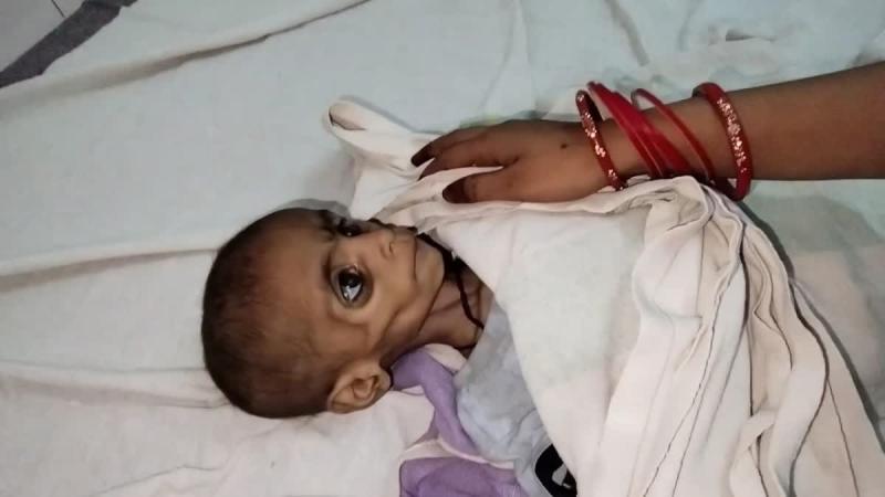 इसे मर जाने दो यह जीकर क्या करेगी कुपोषण से