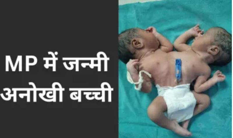 एक शरीर दो सिर और दो दिल वाली बच्ची ने