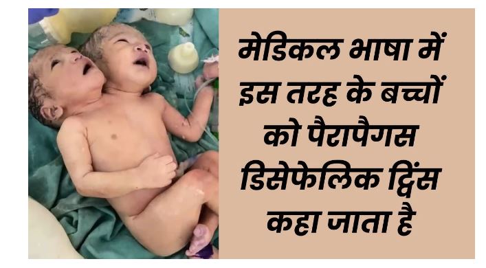 दो सिर दो दिल एक शरीर इंदौर में हुई दुर्लभ शिशु