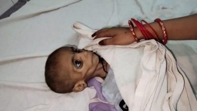 इसे मर जाने दो यह जीकर क्या करेगी कुपोषण से