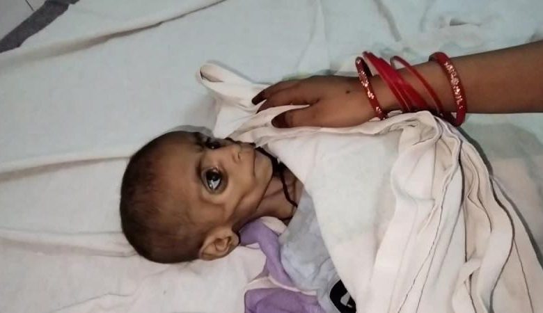 इसे मर जाने दो यह जीकर क्या करेगी कुपोषण से