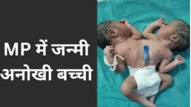 एक शरीर दो सिर और दो दिल वाली बच्ची ने