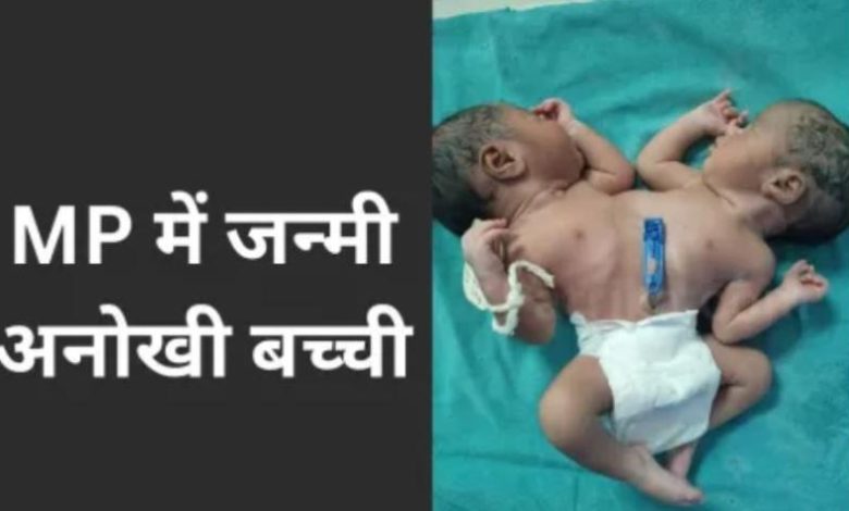 एक शरीर दो सिर और दो दिल वाली बच्ची ने