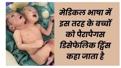 दो सिर दो दिल एक शरीर इंदौर में हुई दुर्लभ शिशु